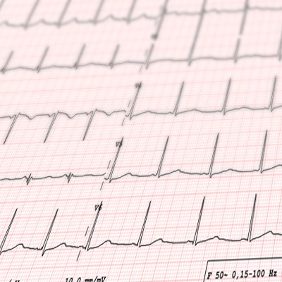 LongQT Interval CArdiac Trait Cell Lines